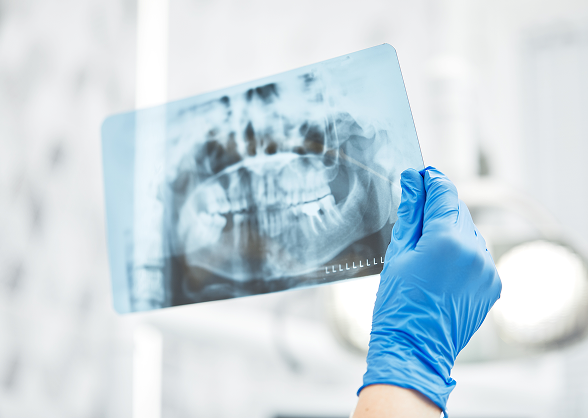 Röntgenbild Zähne